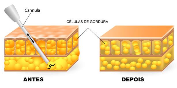 Imagem mostra como as células de gorduras são removidas