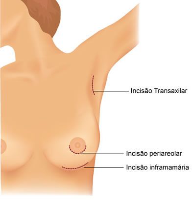 Formas de cicatriz da mamoplastia de aumento