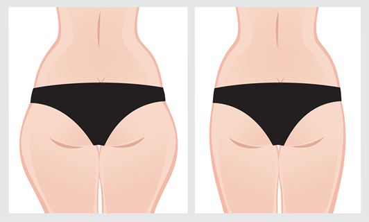Antes e depois da lipoaspiração