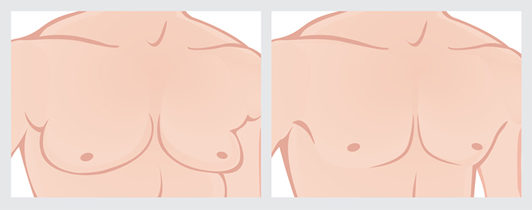ginecomastia antes e depois